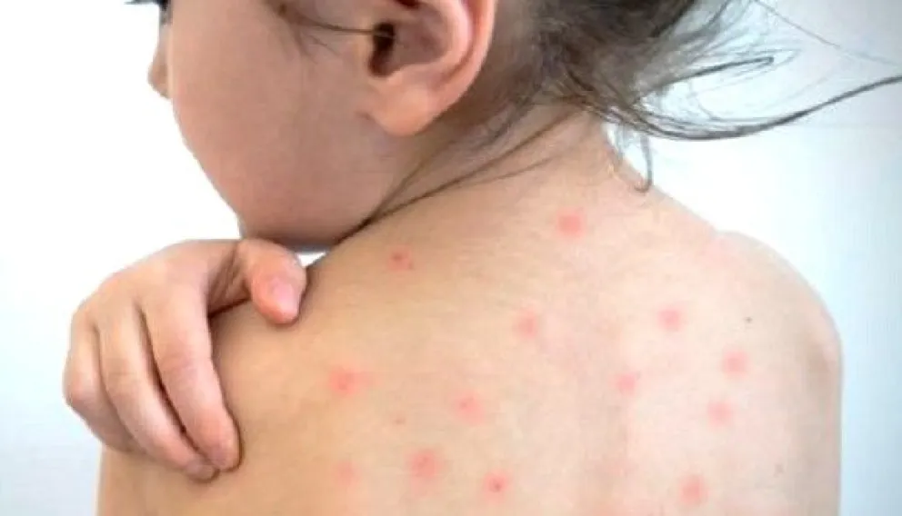 Lanzan la “Vacunatón” en La Paz ante alarmante baja cobertura contra el sarampión