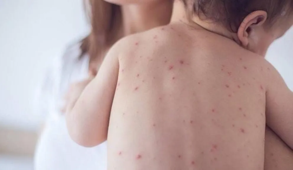 Confirman cuarto caso de sarampión en La Paz: mujer de 23 años en Viacha activa operativo de bloqueo sanitario